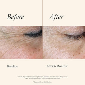 SkinMedica TNS Recovery Complex Facial Treatment - Advanced Growth Factor & Exosome Formula for Skin Rejuvenation - Helps to Improve the Appearance of Fine Lines, Wrinkles, and Uneven Skin Tone (1 Oz)