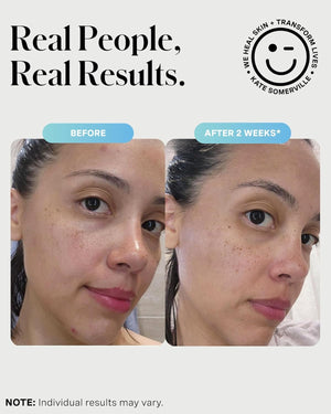 Kate Somerville EradiKate 3% Sulfur Daily Foaming Cleanser Acne Treatment – Clinically Formulated Medicated Face Wash Balances Skin & Cleans Pores, 4 Fl Oz