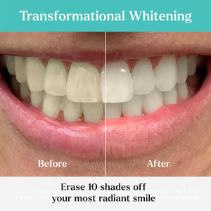 GLO Science So Brilliant Tooth Whitener Set – Fast, Sensitivity Free Teeth Whitening Technology – Includes Warming Mouthpiece with LED Light, 6% Hydrogen Peroxide Gel Pods, Lip Balm, & Travel Case