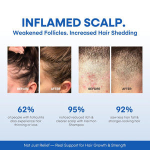 Hermon Folliculitis Shampoo for Itchy Scalp: Psoriasis, Dandruff & Seborrheic Dermatitis & Biotin – Soothes | Exfoliates | Reactivates Follicles 2 Packs