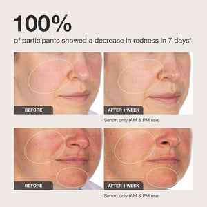 INNBEAUTY Project Calm The Red Down Dual Chamber Serum for Redness, Soothing & Skin Barrier Support, 1.7 OZ (50ml)